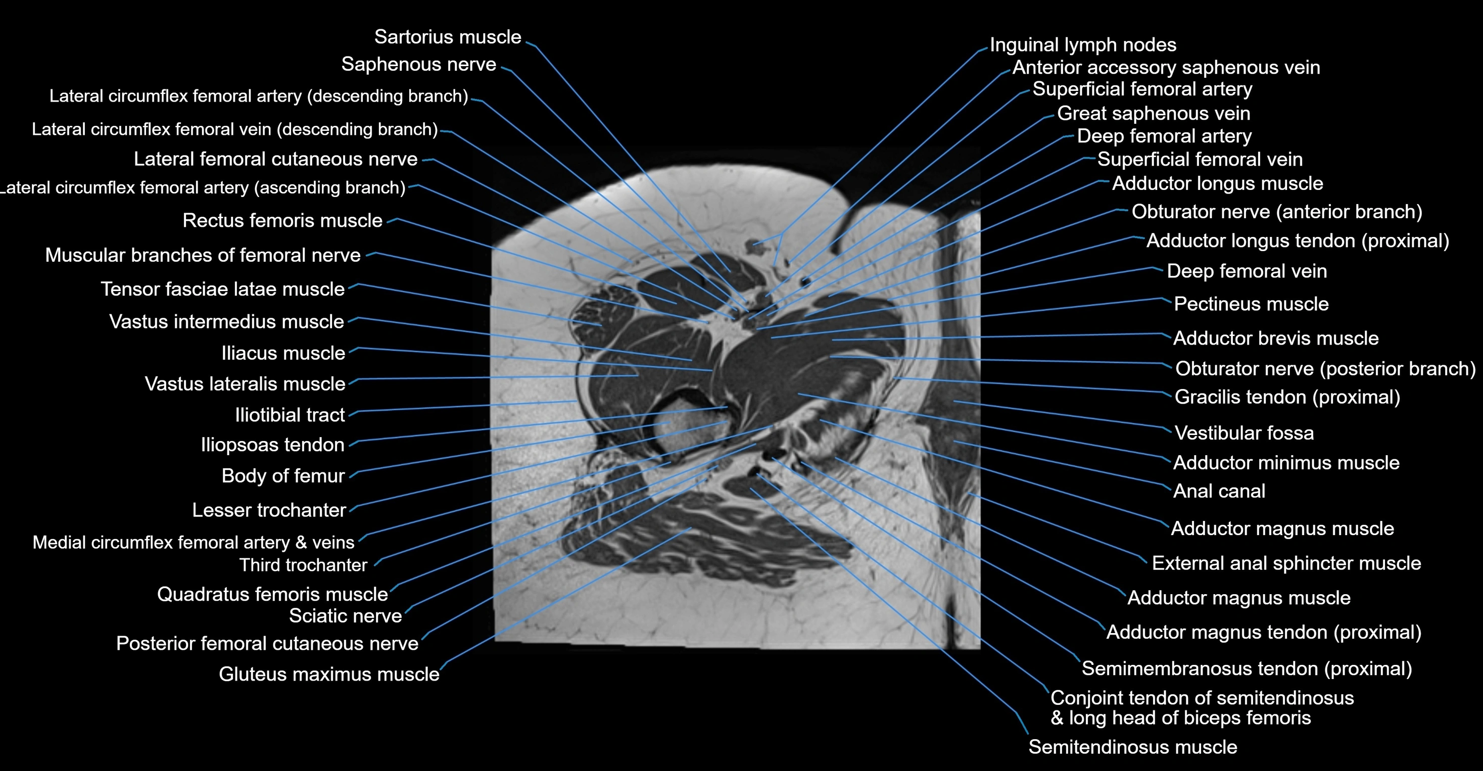 MRI hip axial cross sectional anatomy 3T 3D  radiology  anatomy image-img-00001-00070.webp